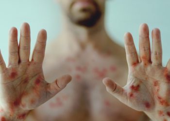 Controle da varíola dos macacos