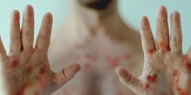 Controle da varíola dos macacos